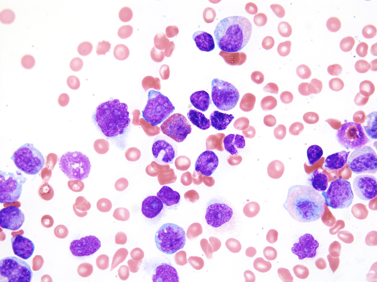 4. Aspirate smear 100x oil